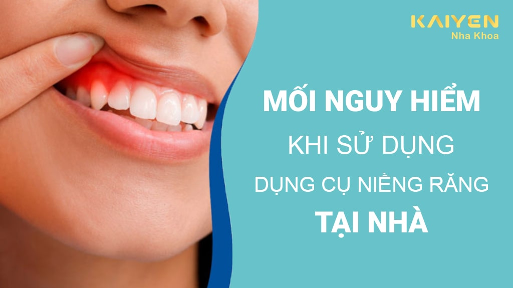 Mối nguy hiểm khi sử dụng dụng cụ niềng răng tại nhà