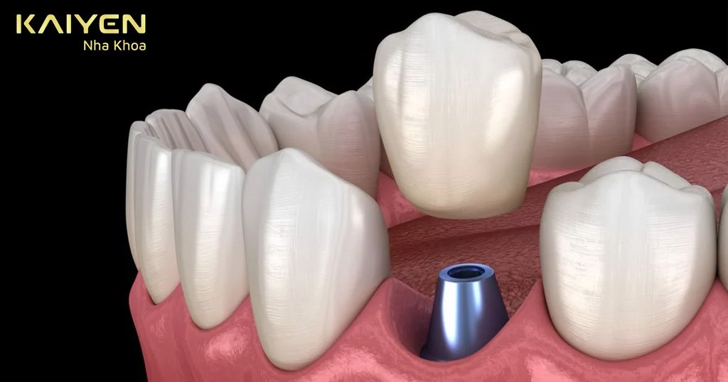 Nhổ răng bao lâu thì cấy implant được