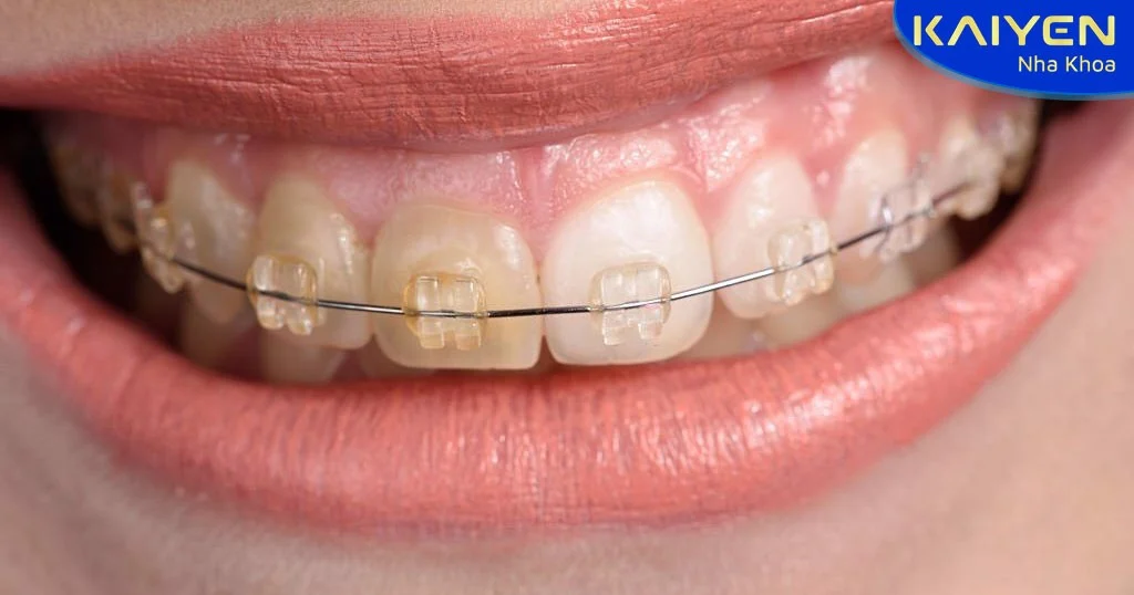 Niềng răng mắc cài pha lê bị ngả màu do không vệ sinh thường xuyên