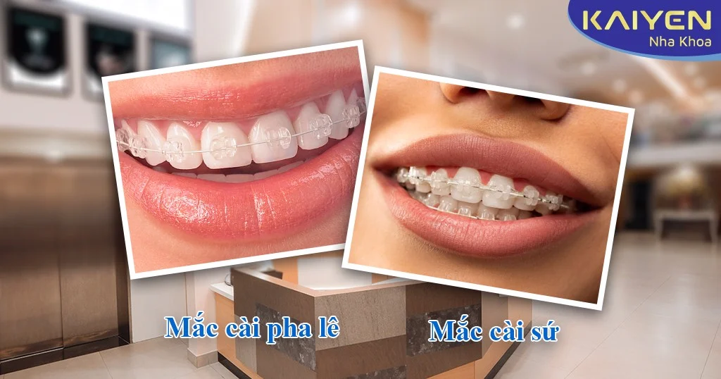 Phân biệt niềng răng mắc cài pha lê và mắc cài sứ