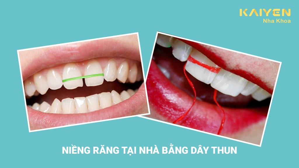 Niềng răng tại nhà bằng dây thun