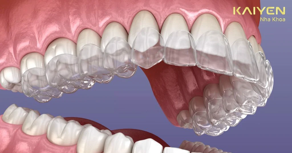 Niềng răng Invisalign làm từ chất liệu đặc biệt