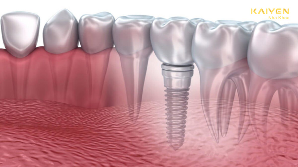 Trồng răng Implant cho người già có được không?