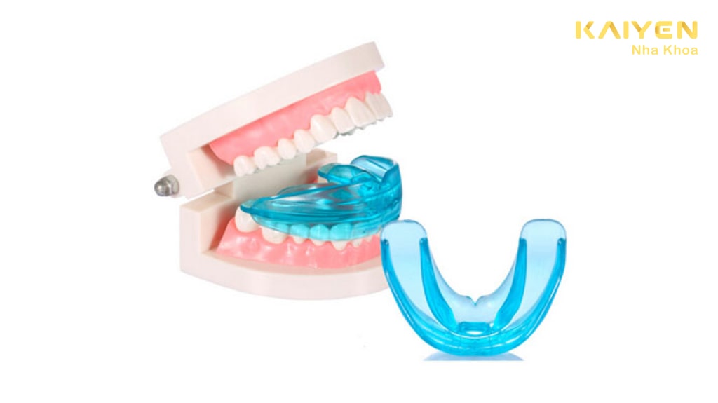 Tại sao nhiều người lựa chọn niềng răng tại nhà