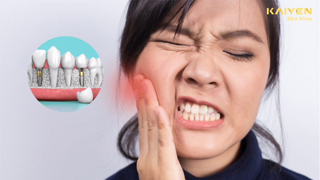Trồng răng implant có bị sưng đau không