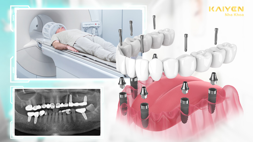 Trồng răng implant có chụp mri được không