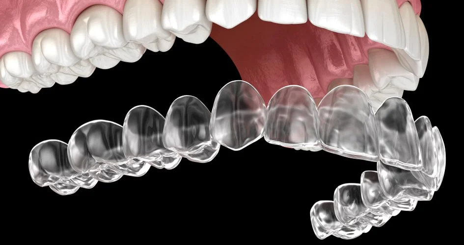 Niềng răng Invisalign hoạt động như thế nào?