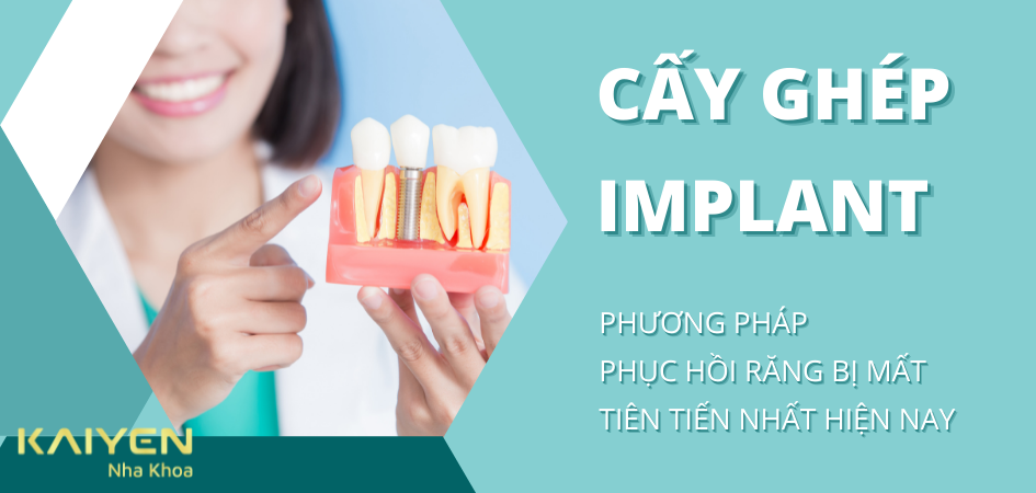 Phương pháp cấy ghép Implant