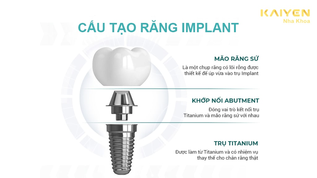 Cấu tạo răng Implant