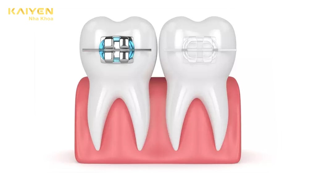Điểm giống nhau giữa mắc cài sứ và kim loại