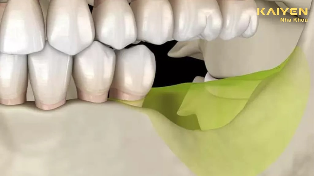 Mất răng dẫn đến tình trạng tiêu xương hàm là lý do tại sao phải trồng răng implant