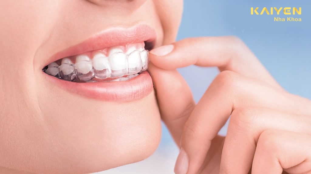 Niềng răng Invisalign