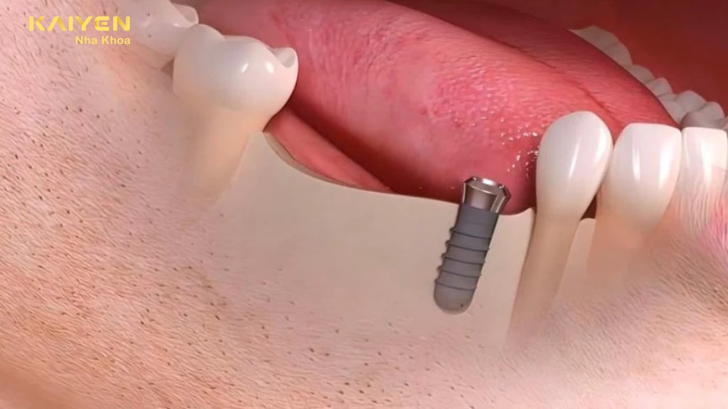 Răng Implant bị lệch