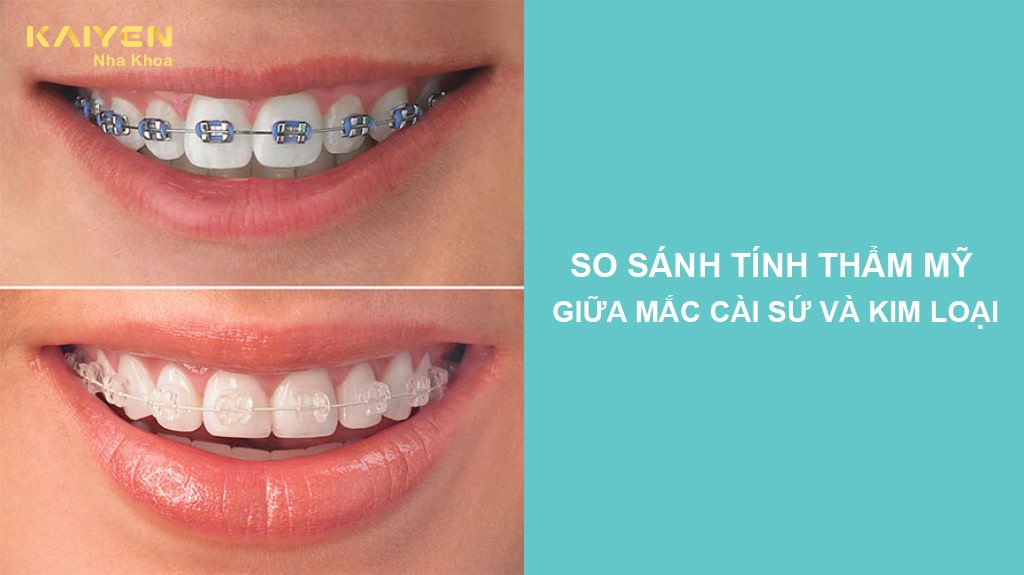 So sánh tính thẩm mỹ giữa mắc cài sứ và kim loại