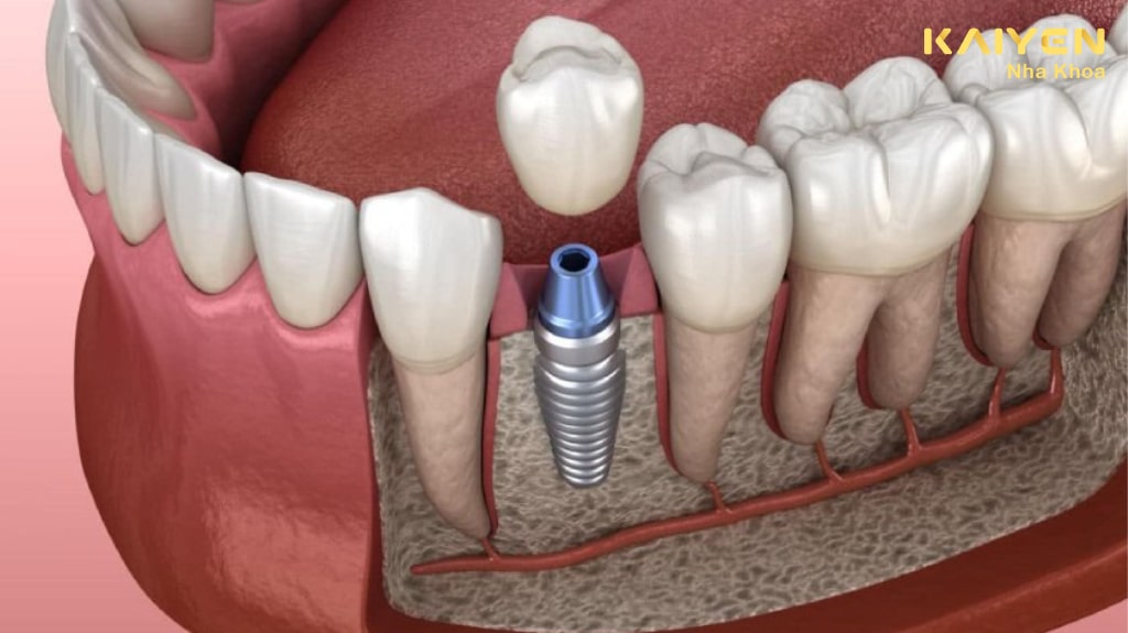 So sánh trồng răng implant và phương pháp khác