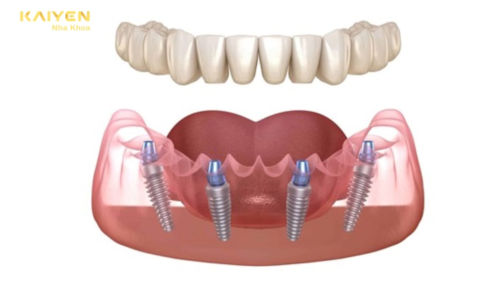 Tại sao nên tìm hiểu về quy trình trồng răng Implant
