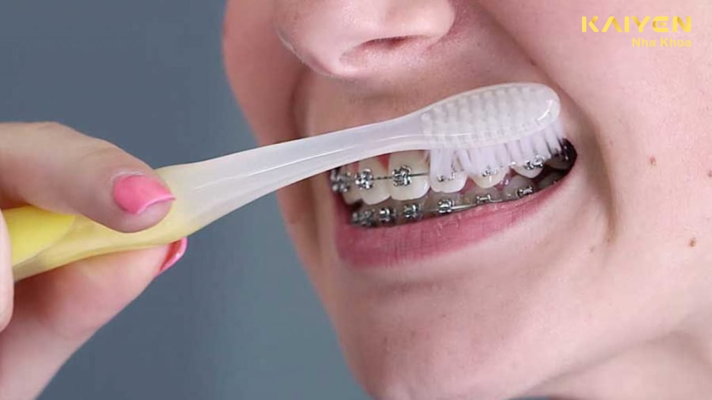 Thói quen vệ sinh răng miệng khi niềng răng