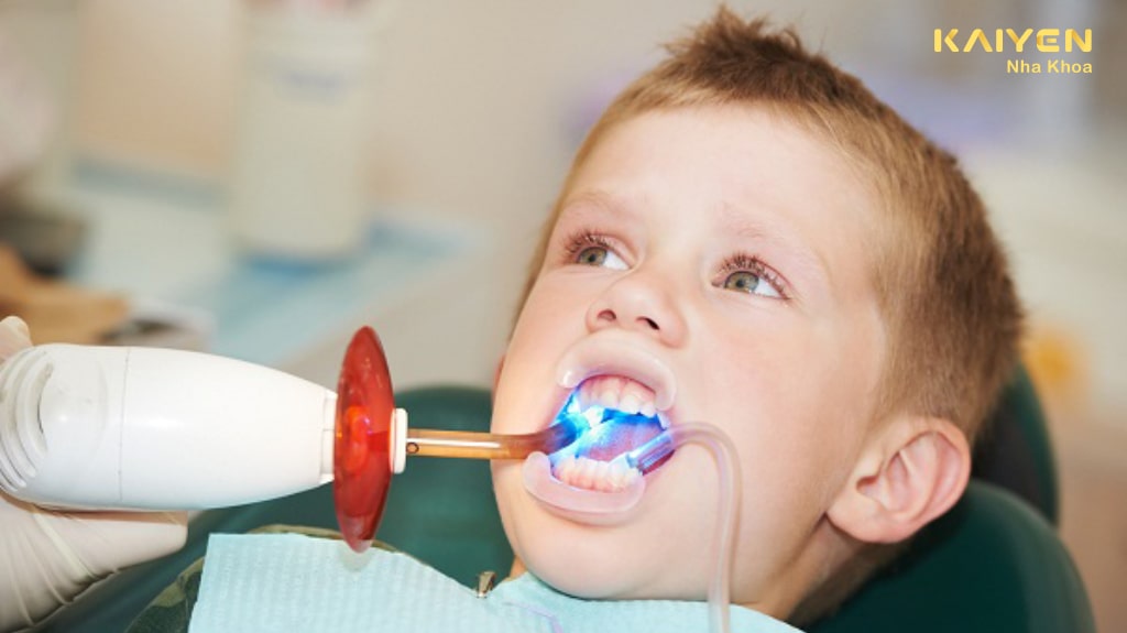 Trám răng cho trẻ em