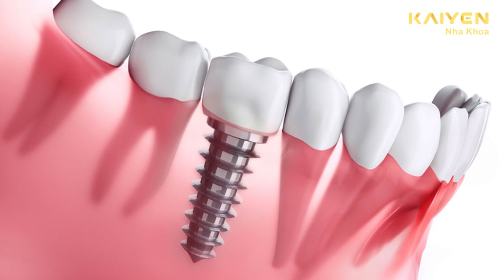 Trồng răng implant cải thiện chức năng ăn nhai