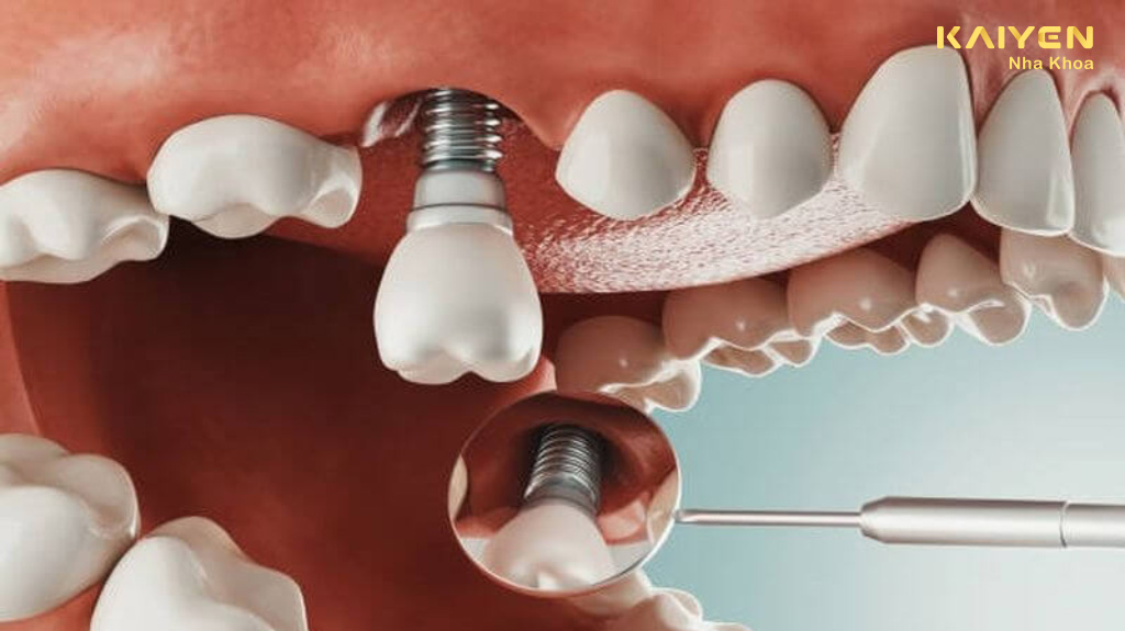 Trồng răng implant giúp cải thiện chức năng ăn nhai