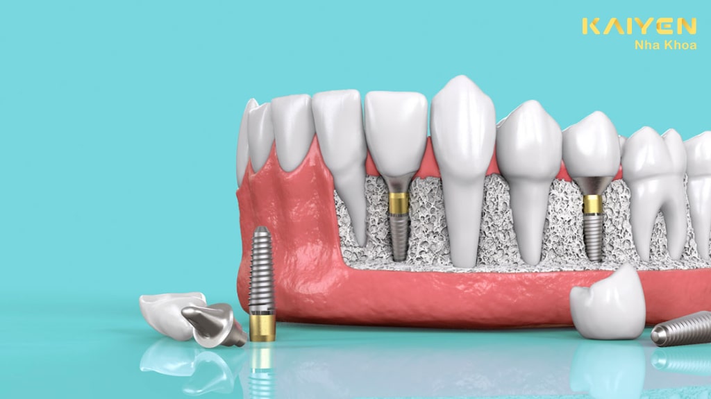 Trồng răng implant vững chắc có độ bền lâu dài