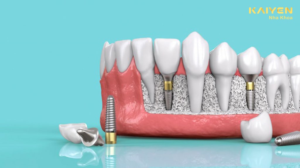 Vậy trồng răng Implant có chụp MRI được không?