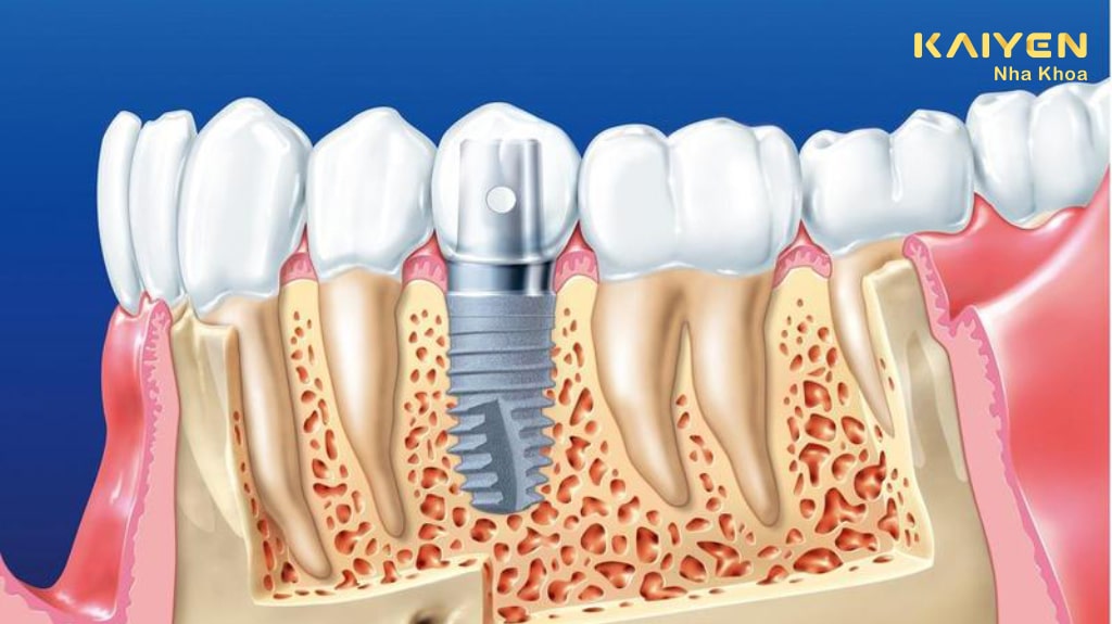 Vì sao trồng răng implant được nhiều người tin tưởng