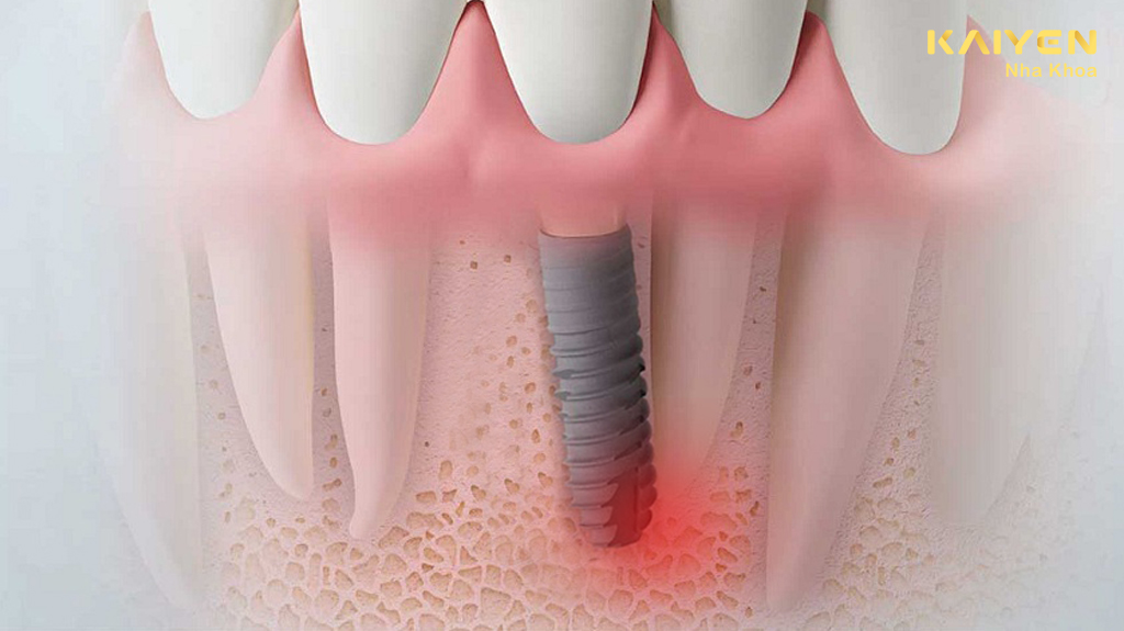 Dấu hiệu nhận biết viêm quanh implant