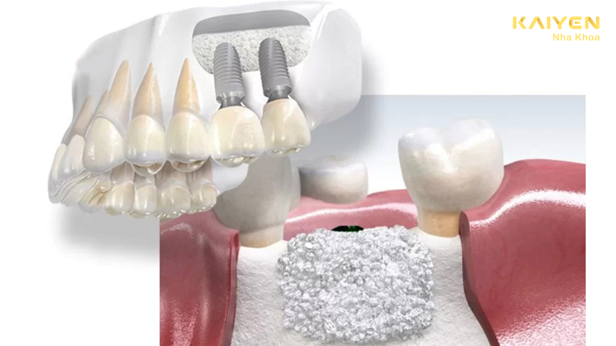 Tiêu xương hàm có trồng răng được không?
