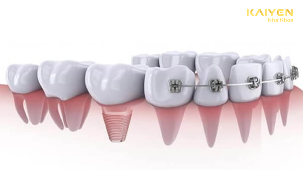 Nên niềng răng trước hay trồng răng implant trước