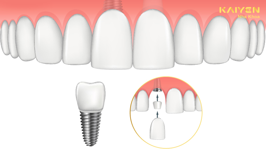 Phục hình sứ trên implant không chuẩn xác