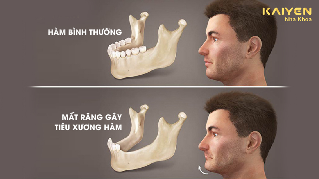 Tiêu xương ảnh hưởng đến răng miệng