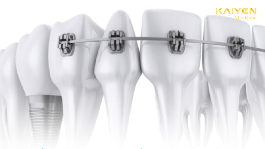 Trồng răng implant có niềng răng được không?