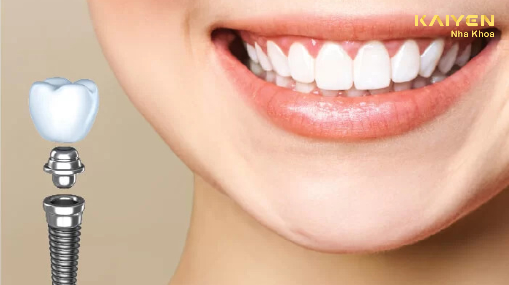 Vì sao trồng răng implant được nhiều người lựa chọn