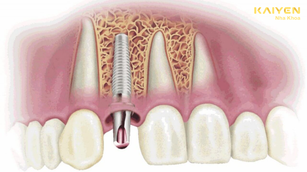 Dấu hiệu răng implant bị đào thải