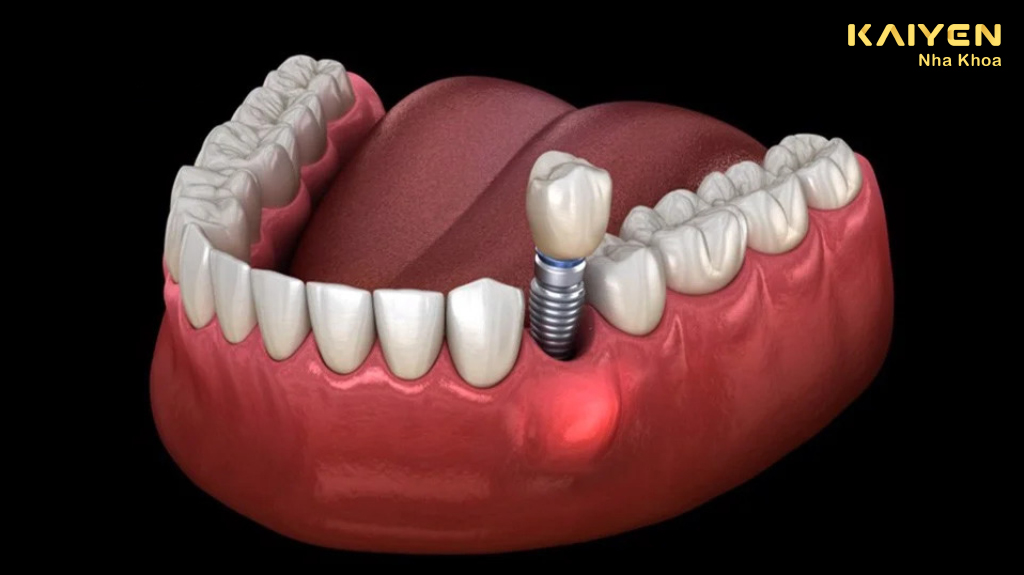 Răng implant bị đào thải là gì?