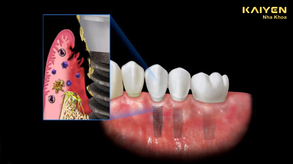 Răng implant bị viêm nhiễm