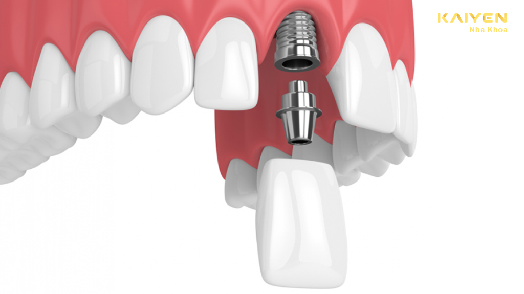 Trồng implant răng cửa
