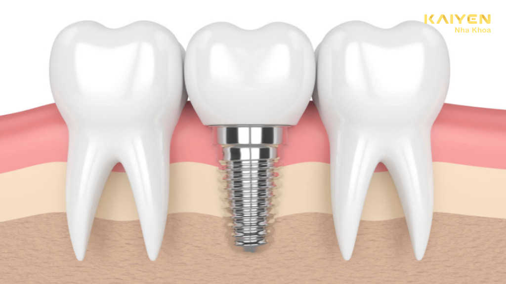 Ưu điểm trồng răng Implant