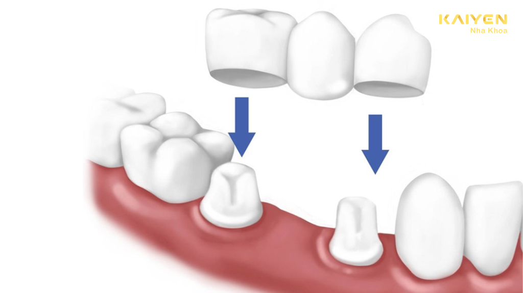 cầu răng sứ và implant