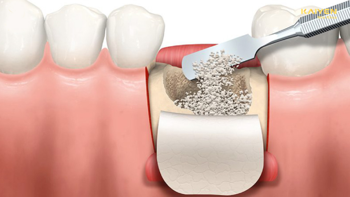 Ghép xương răng là gì