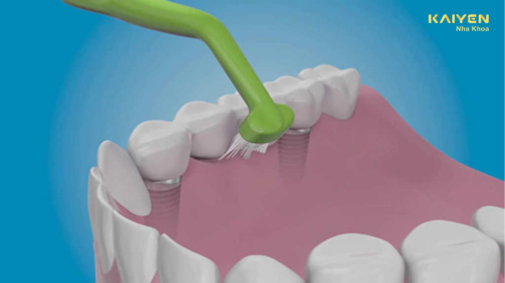 Tại sao cần vệ sinh răng implant đúng cách