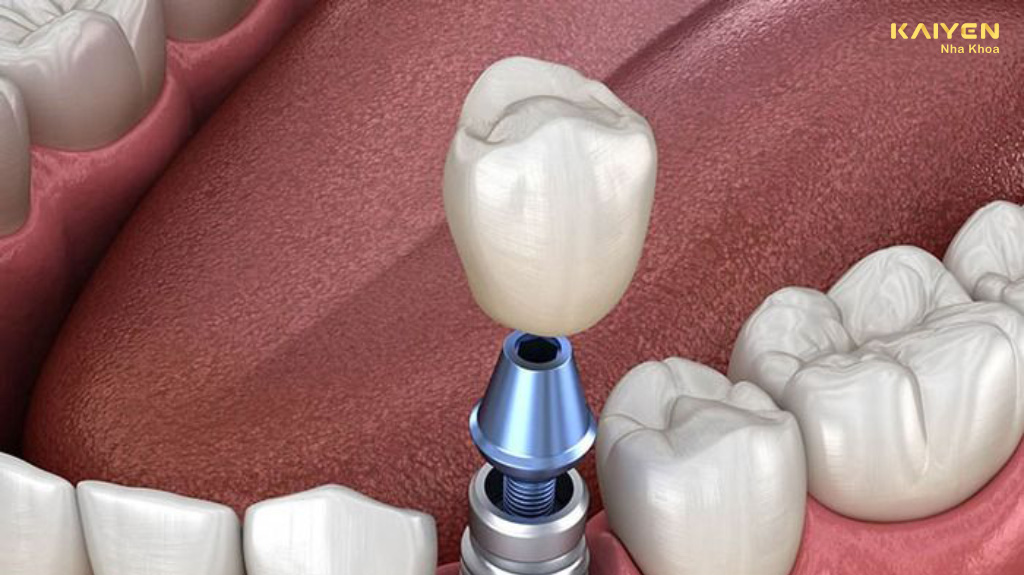Trồng răng nanh bằng phương pháp trồng răng Implant