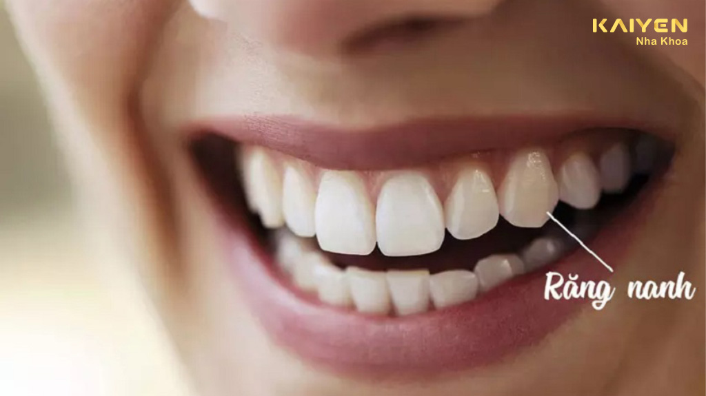 Răng nanh là gì?