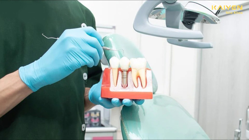 Trồng răng cấm bằng implant