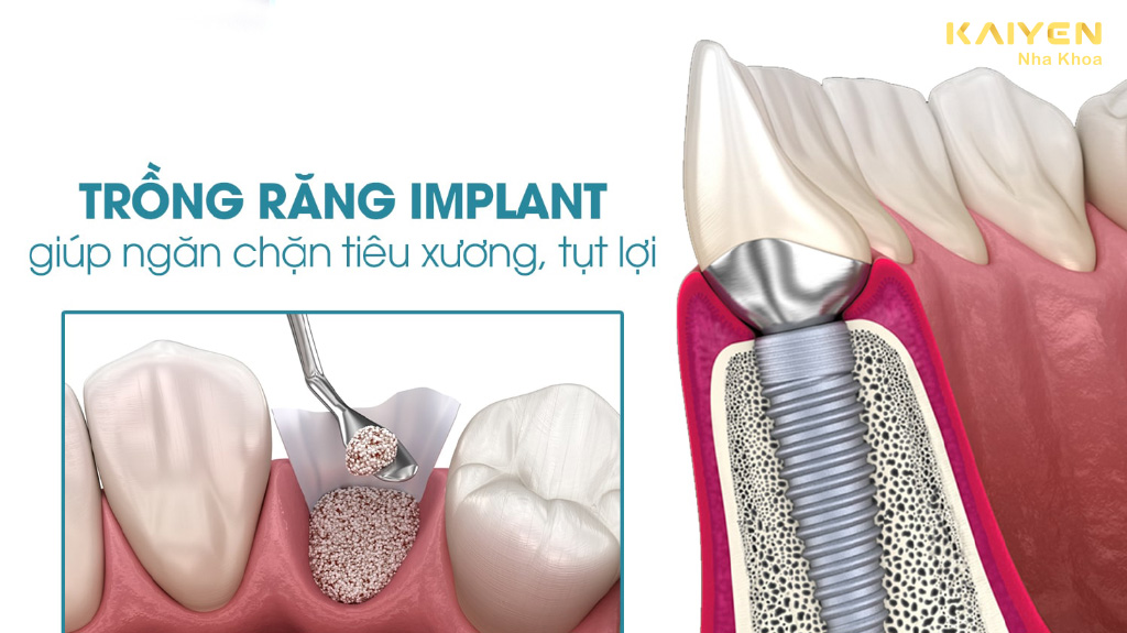 Trồng răng implant bị tiêu xương có được không?