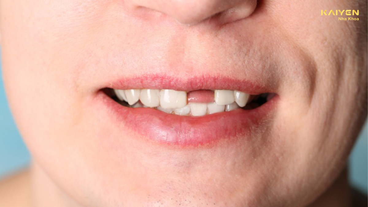 Trồng răng khi còn chân răng