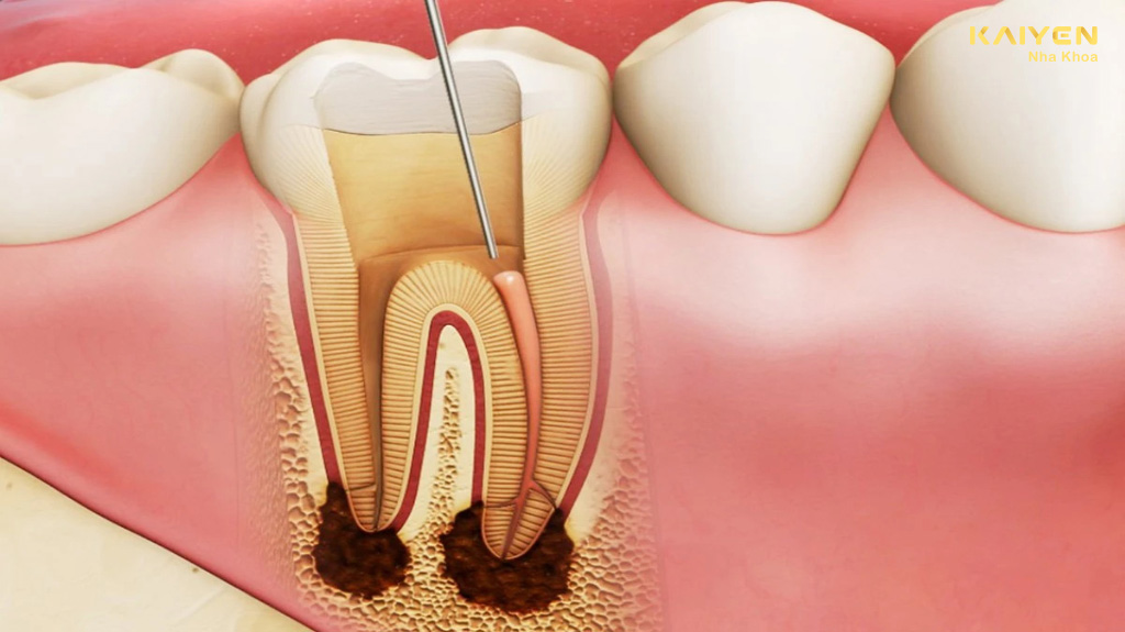 áp xe răng khôn là gì?