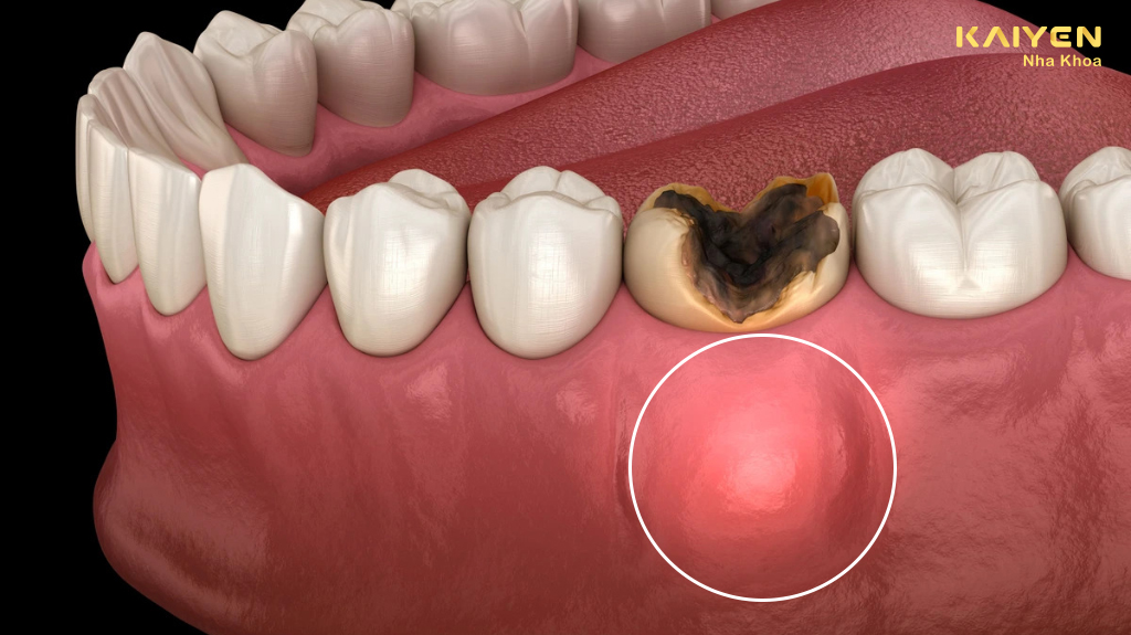 Cách điều trị áp xe răng