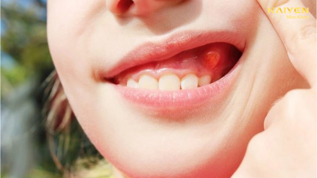 Nguyên nhân gây ra tình trạng áp xe răng